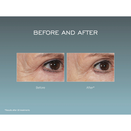 Youth Activator (Infrared LED & Radio Frequency) Anti-Aging Device Set - with 1 Free Contouring Serum